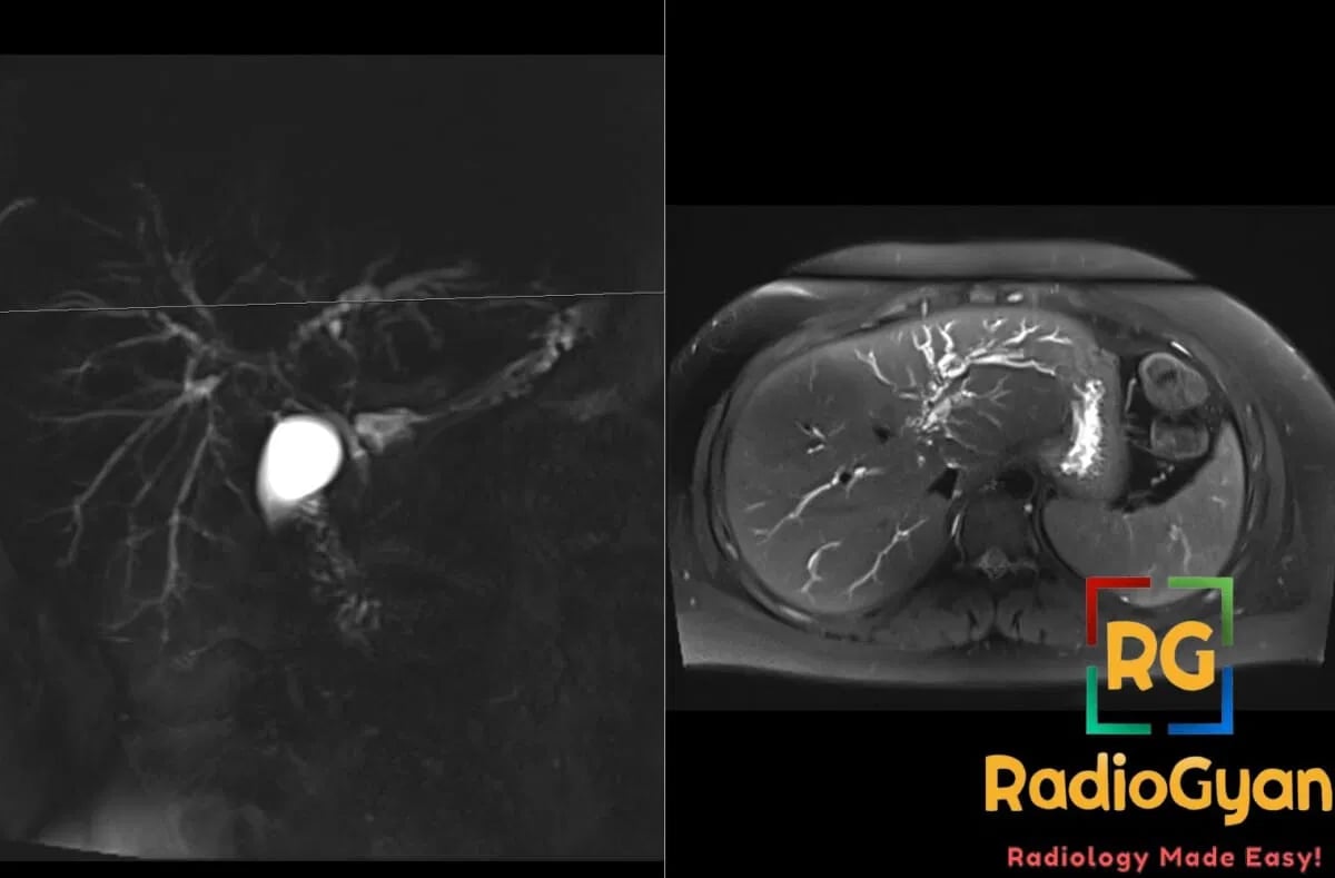 MCRP and axial T2 weighted MRI showing dilated intrahepatic ducts with a beaded morphology in a patient with primary sclerosing cholangitis.