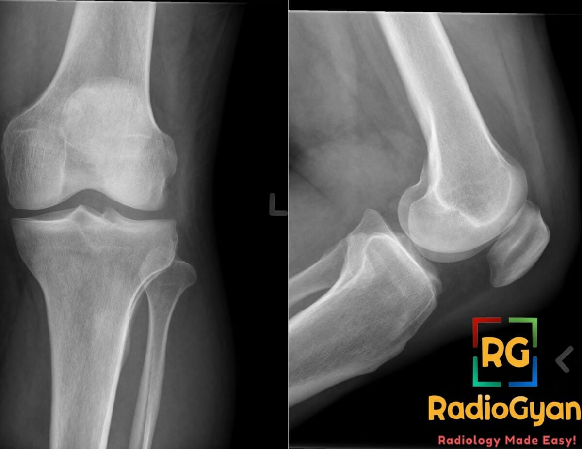 Anteroposterior and lateral radiographs of the knee joint showing soft tissue thickening anteriorly in a patient with prepatellar bursitis housemaid knee 