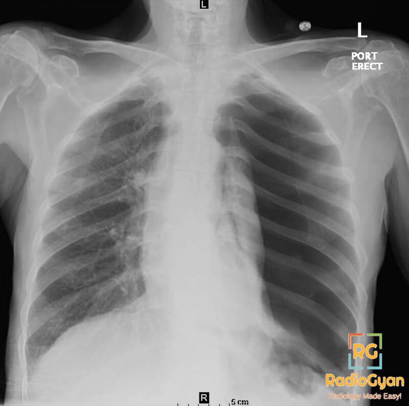 Chest radiograph showing left sided tension pneumothorax