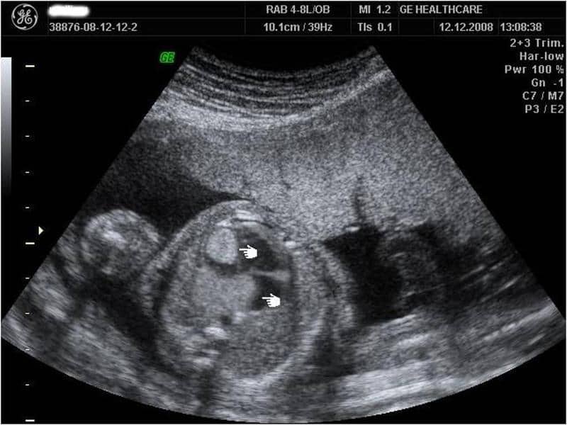 Fetal Cardiac Rhabdomyoma