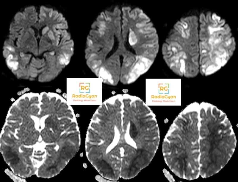 Hypoxic ischemic encephalopathy Radiology