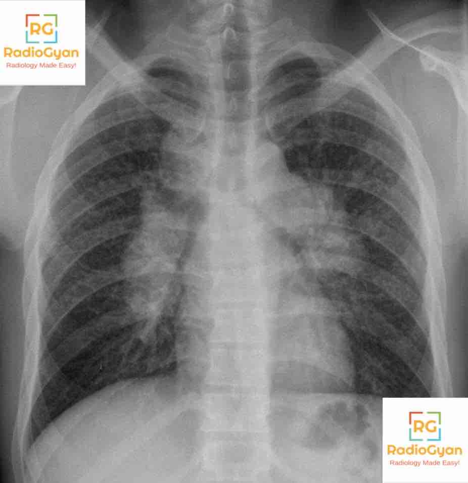 Radiology Spotters set 19 - Plain film Radiology spotters RadioGyan.com