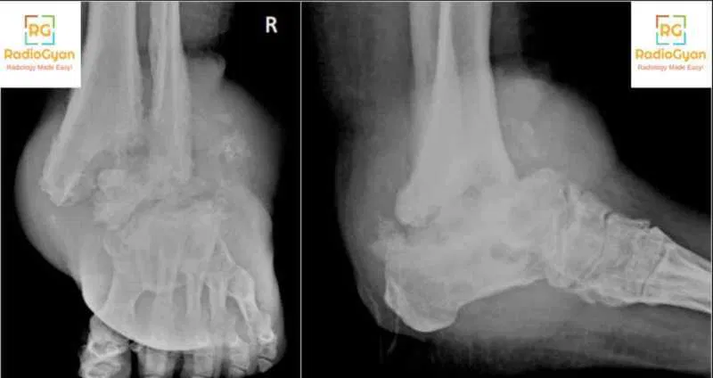 Radiology Spotters set 21 - Plain film Radiology Spotters | RadioGyan.com