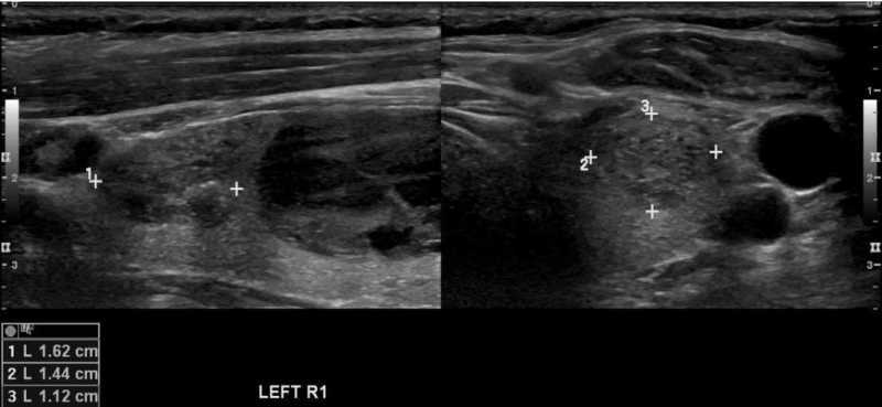 TIRADS example 1 TIRADS example 1