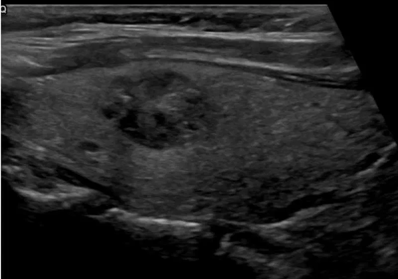 TIRADS example 3 RadioGyan.com