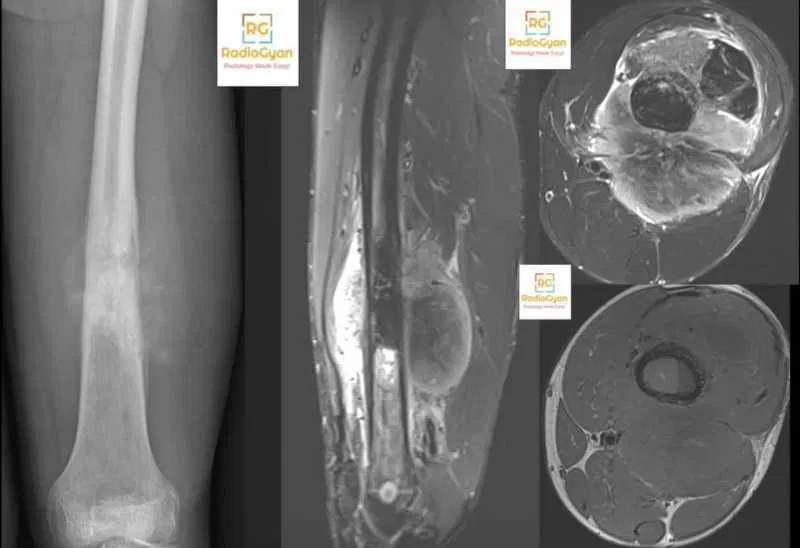 Osteosarcoma - MSK MRI teaching cases Spotters set 30