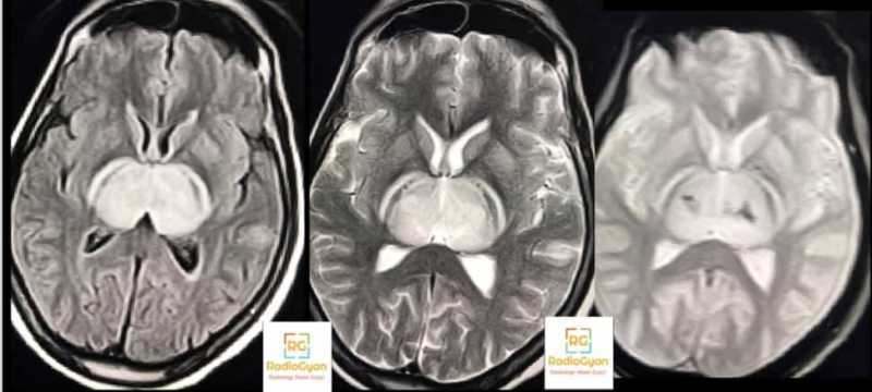 Dengue encephalitis Interesting radiology cases