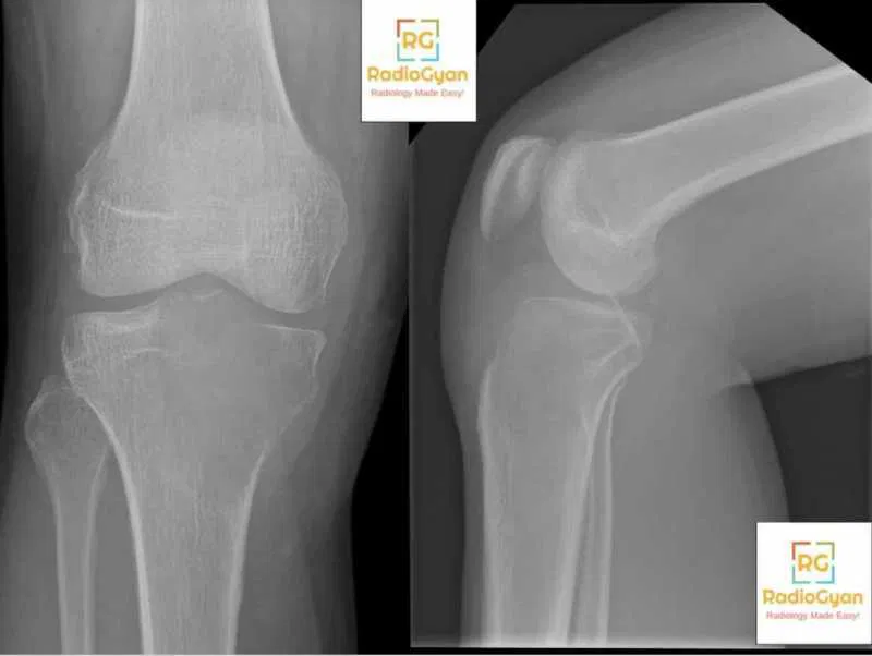 GCT Bone tumors radiology