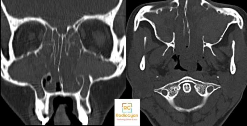 Sinonasal Polyposis Radiology Cases Quiz