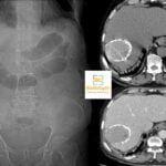 Hydatid cyst Radiology Cases Quiz