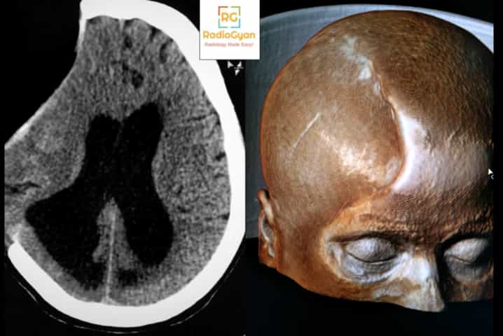Sinking Skin Flap Syndrome CT and 3D image