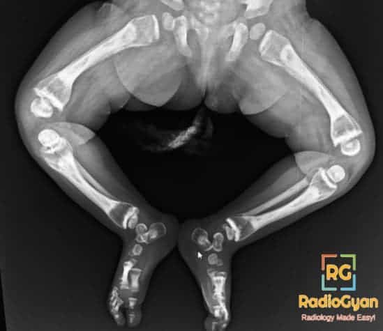 Interesting Radiology cases Bone in bone appearance on a radiograph in a child