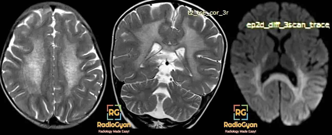 Radiology Quiz case MRI showing tigroid appearance in a case of metachromatic leukodystrophy