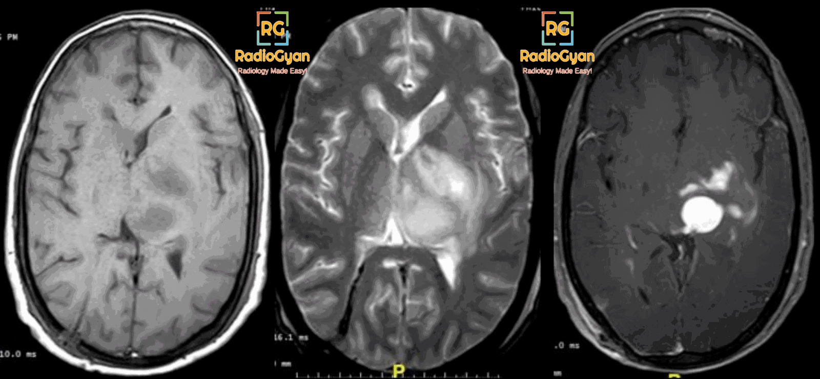 MRI showing a brain tumor - glioblastoma multiforme (GBM)