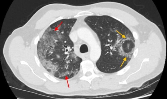Coronavirus radiology CT imaging features atoll sign reverse halo sign