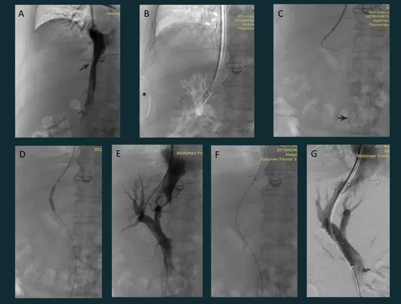 Transjugular intrahepatic portosystemic sh IR case