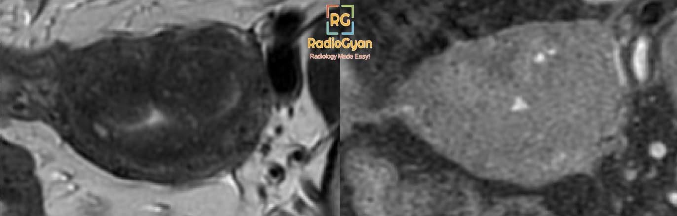 Adenomyoma MRI axial T2 and T1 fat saturated images - Adenomyosis
