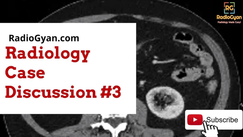 Dropped Galls tones radiology features