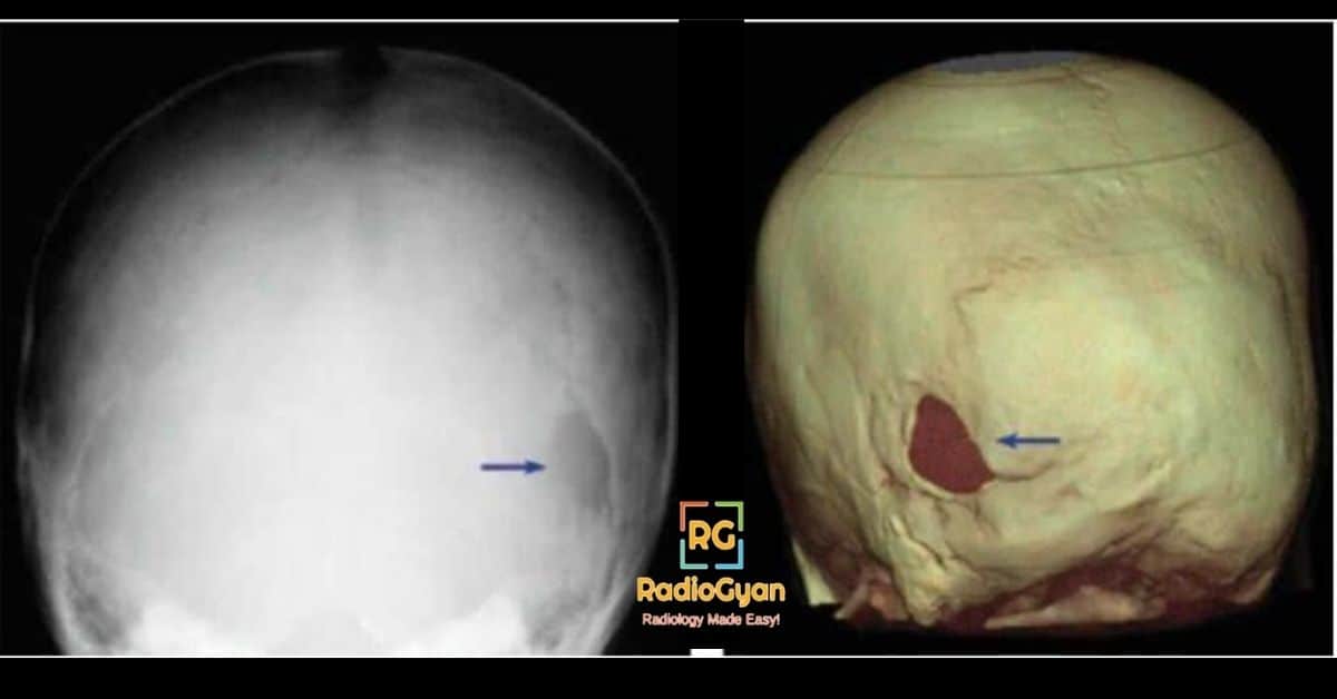 Asterion defect in Neurofirbomatosis 1