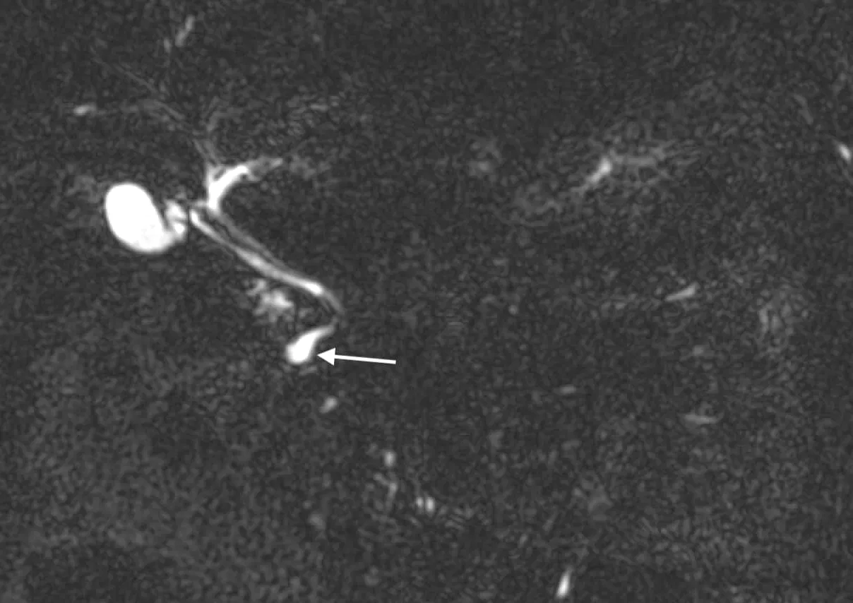 MRCP MRI image showing a choledochocele type III choledochal cyst
