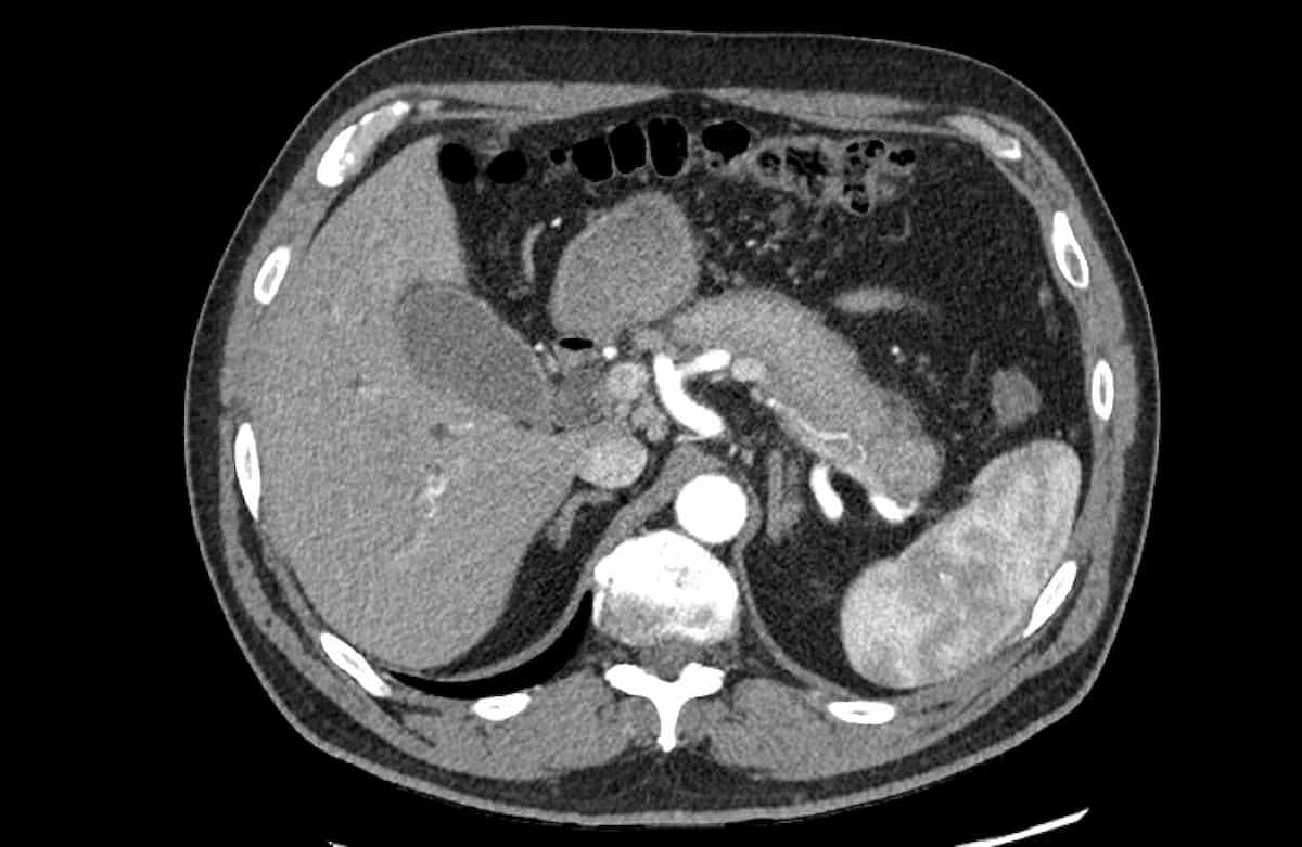 Sausage shaped pancreas with a hypo-attenuating halo suggestive of autoimmune pancreatitis.