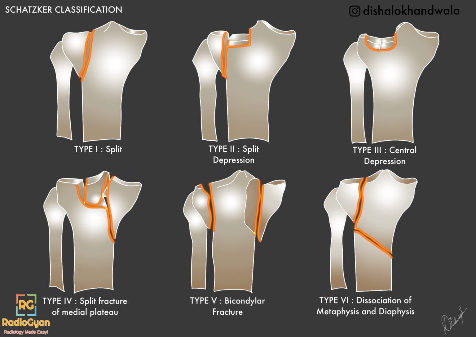 Scthker Classification Schatzker Classification of Tibial Plateau Fractures (Types I–VI)