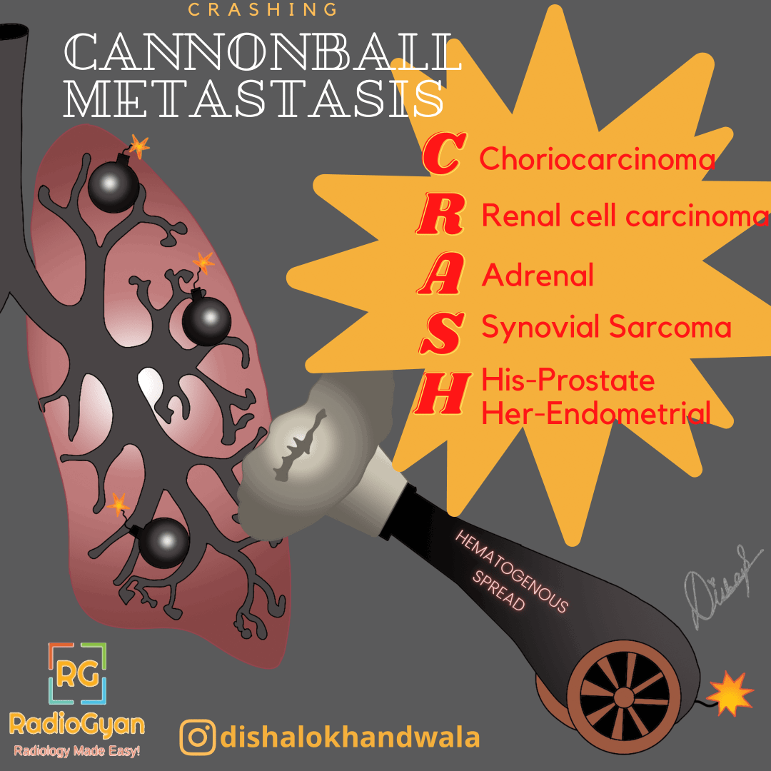 Causes Of Cannonball Mets Visual Mnemonics RadioGyan