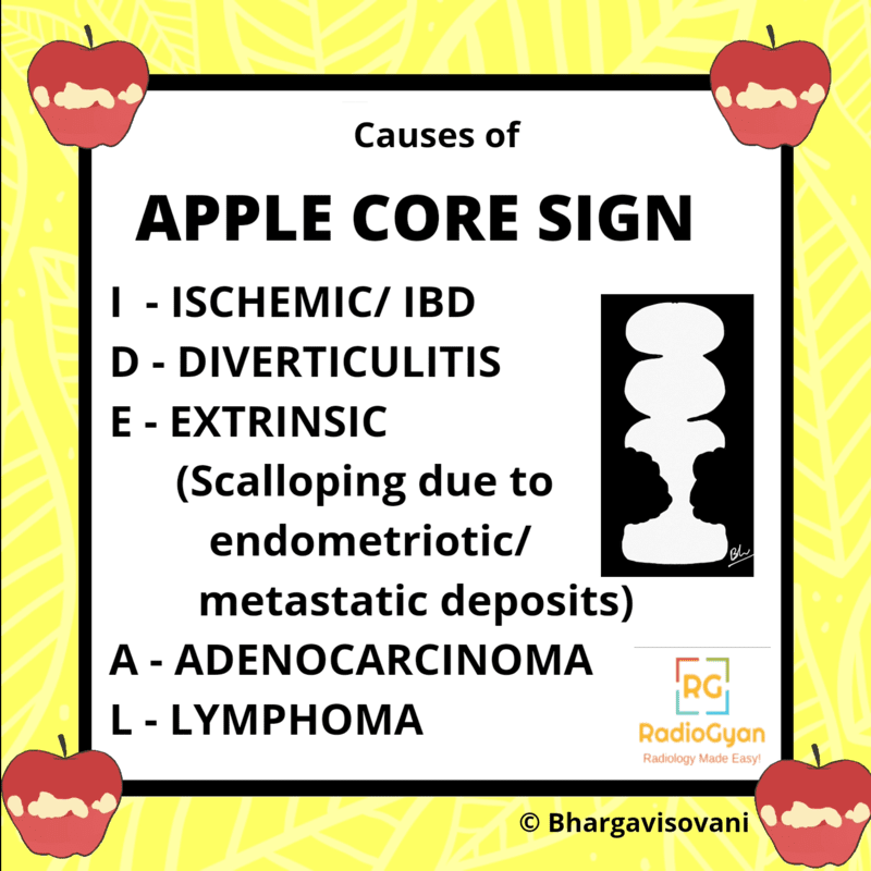 Apple Core Sign Differentials