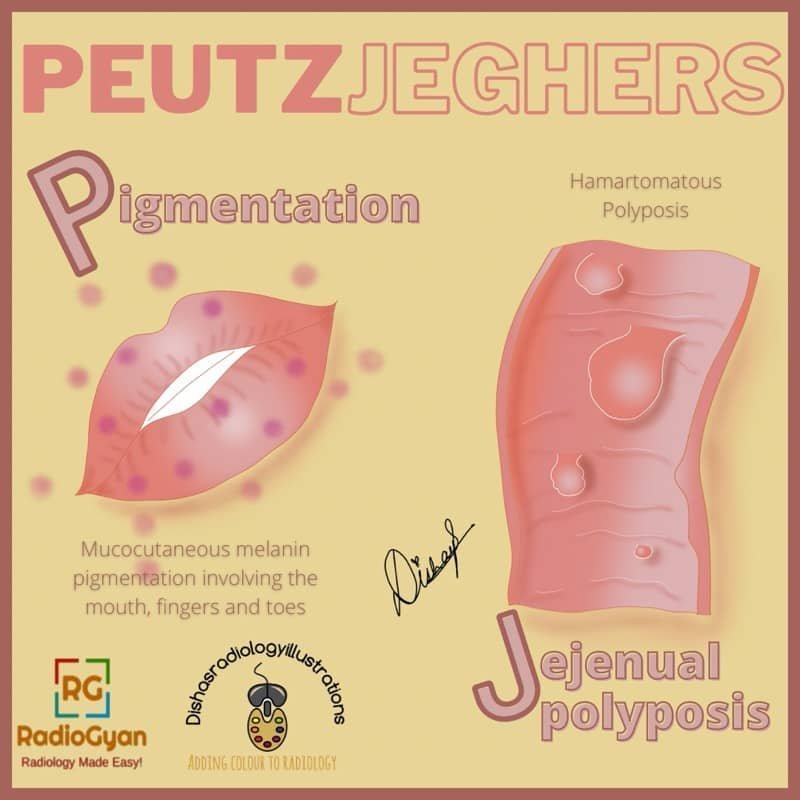 Peutz Jeghers Mnemonic