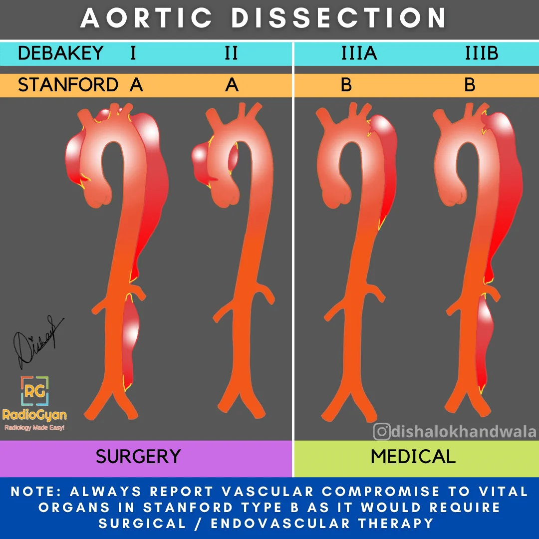 case study of patient with aortic dissection