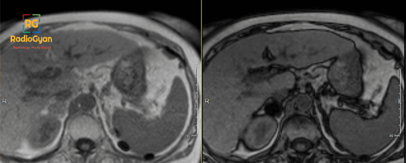 Adrenal Adenoma Chemical Shift Imaging MRI