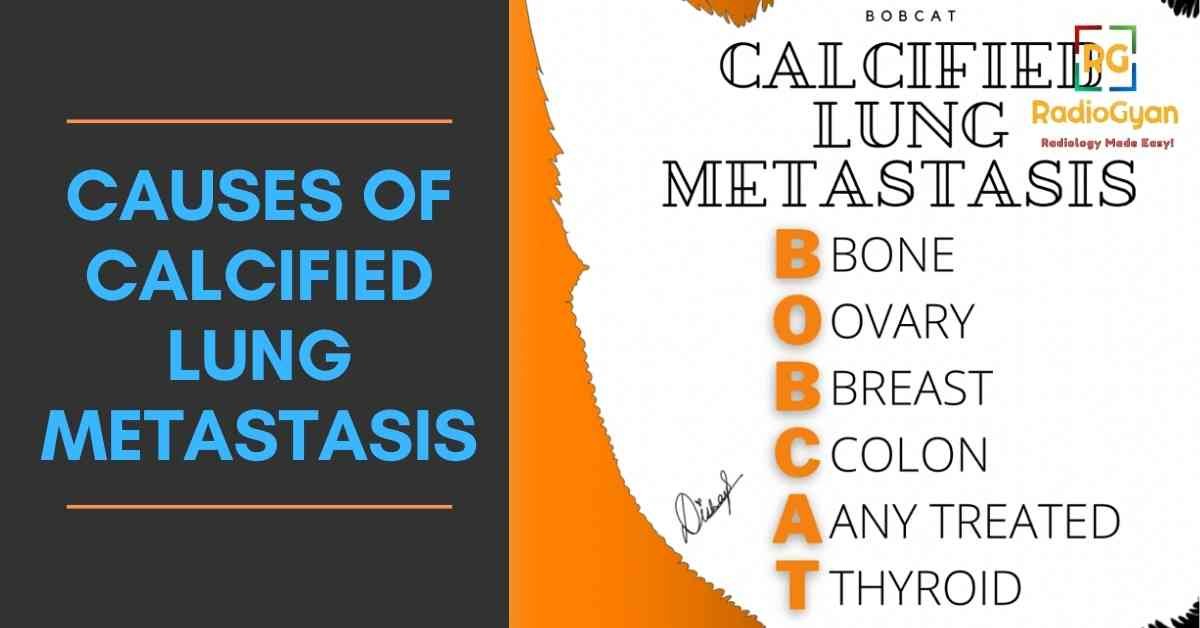 Causes of Calcified Lung Metastasis