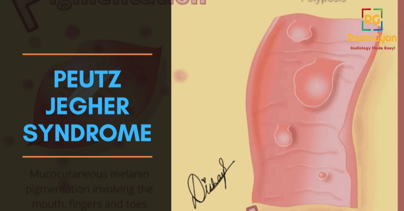 Illustration showing a histological section of the bowel demonstrating polyposis in Peutz-Jegher syndrome.