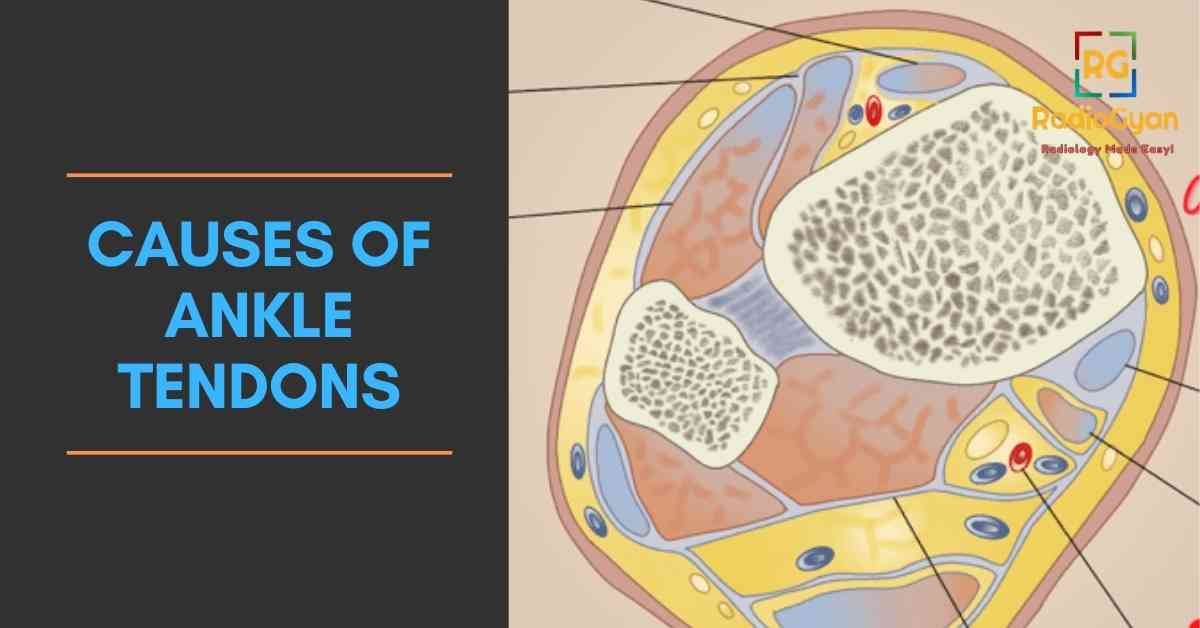 causes of Ankle Tendons