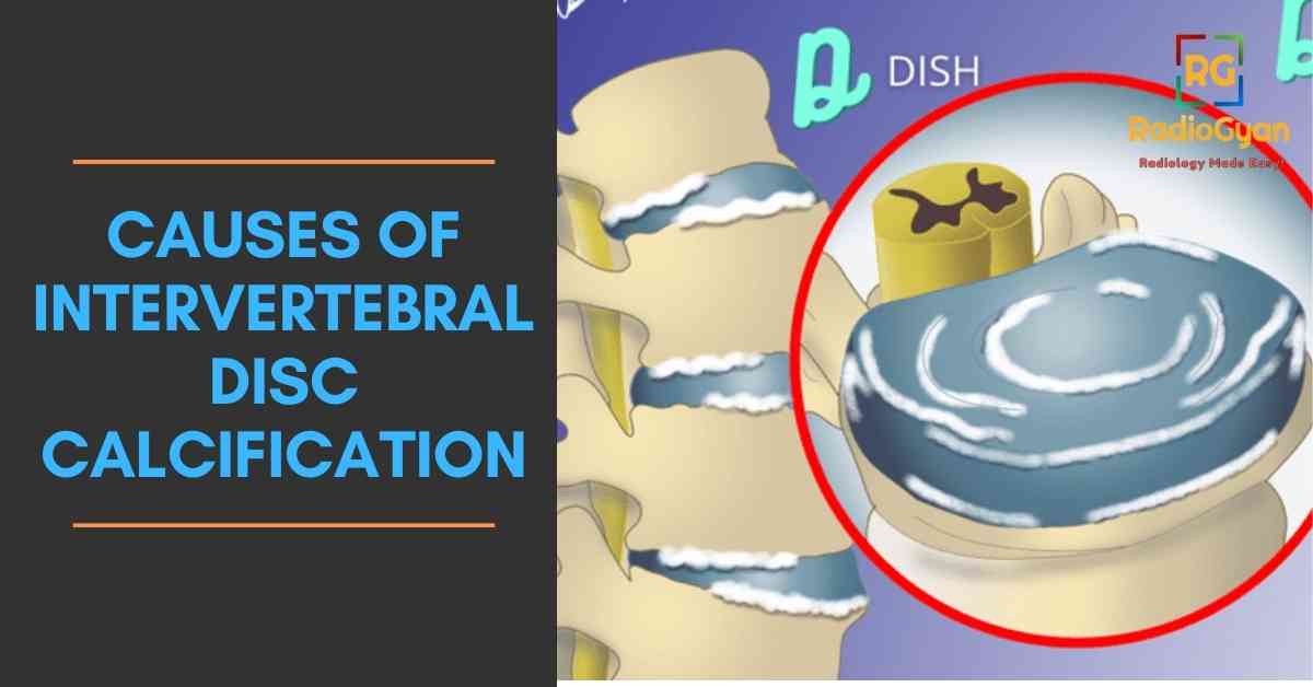 Causes Of Intervertebral Disc Calcification Visual Mnemonics RadioGyan
