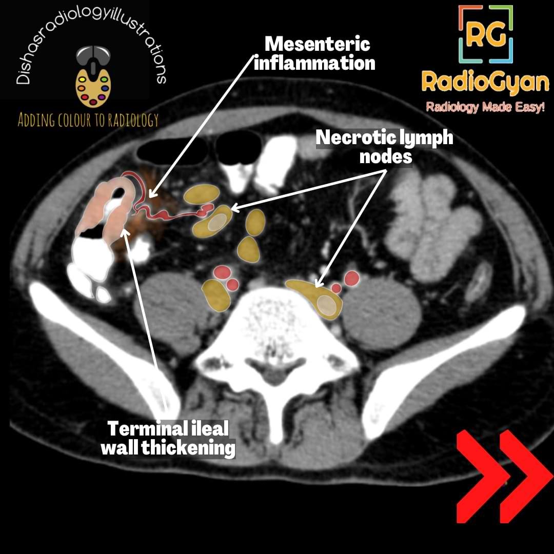 Annotated CT image showing ileocecal tuberculosis with necrotic mesenteric nodes