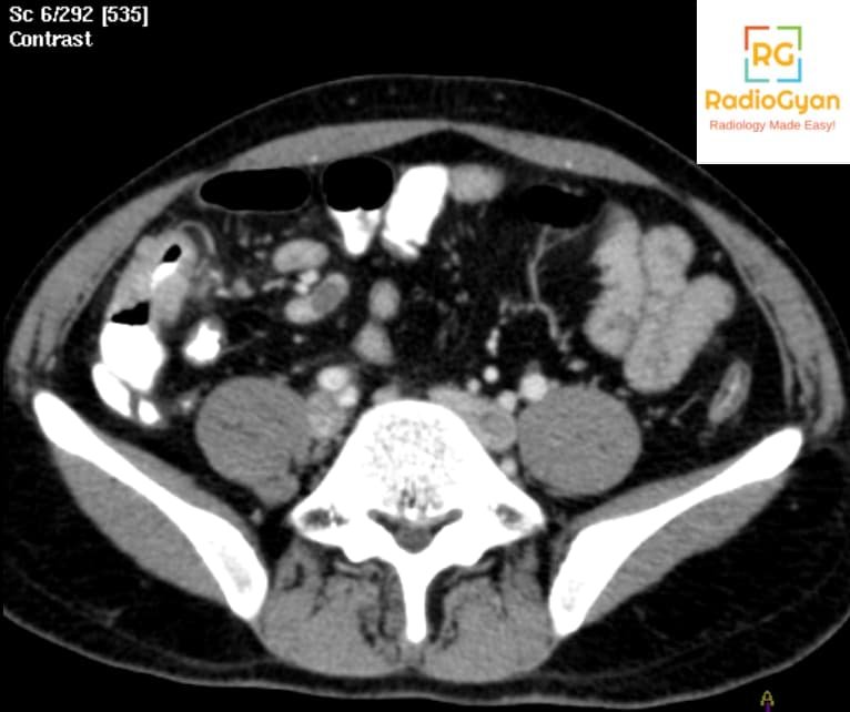 CT image showing ileocecal thickening and necrotic mesenteric lymph nodes in tuberculosis