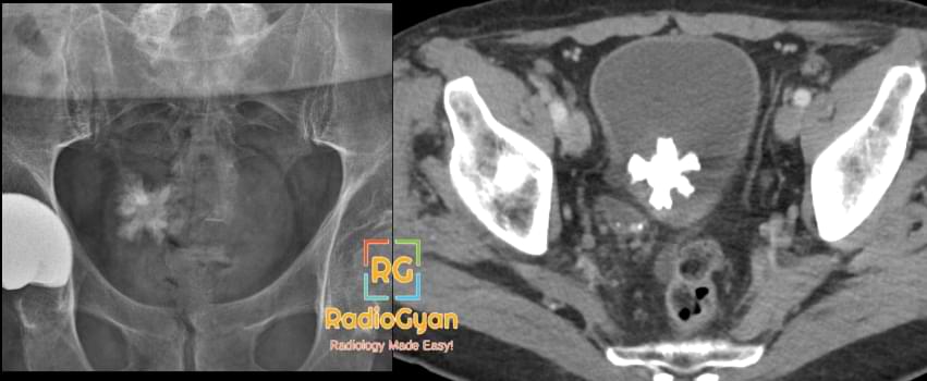 Jackstone Urinary bladder calculus on CT