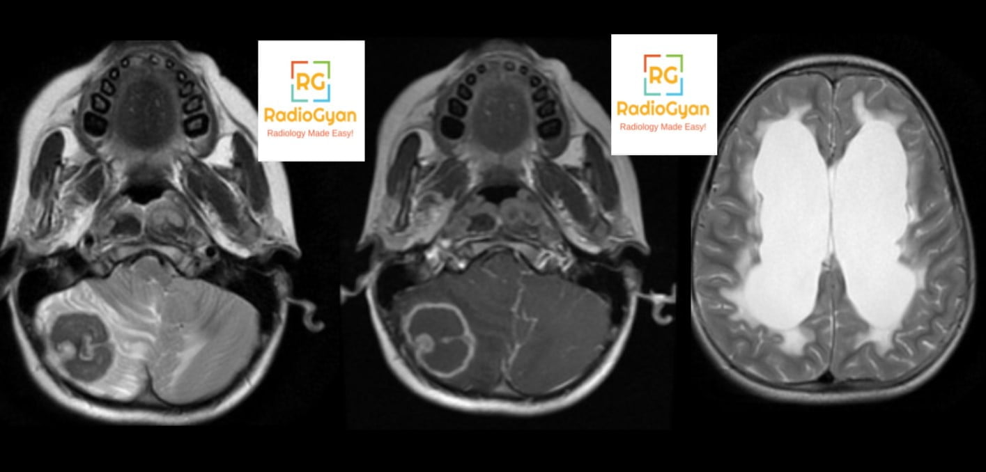 MRI showing a right cerebellar ring-enhancing tuberculoma with meningitis and resultant hydrocephalus