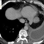 Split Pleura Sign – Empyema Radiology Case.