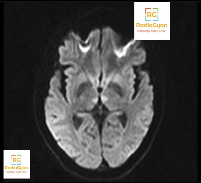 Axial diffusion-weighted MRI showing symmetrical bilateral paramedian thalamic restricted diffusion from artery of Percheron infarction