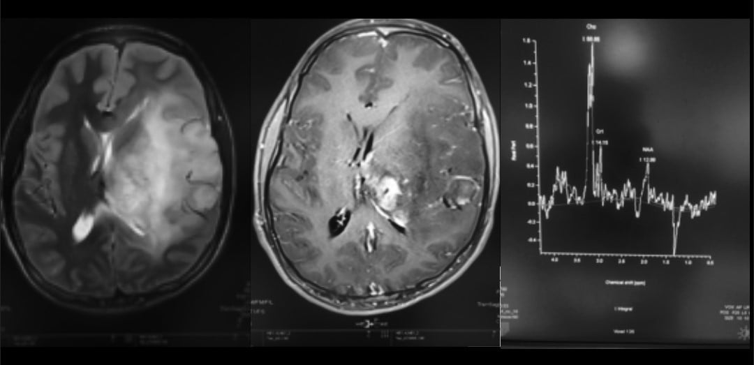 High-Grade Glioma Radiology Case.