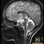 J – Shaped Sella Radiology Case.