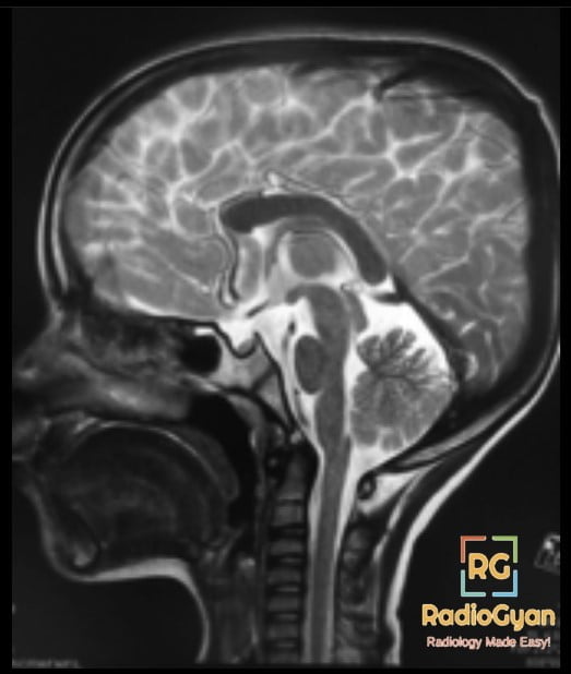 J – Shaped Sella Radiology Case.