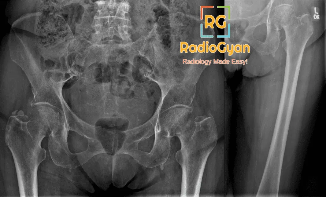 Left femoral subcapital fracture radiograph
