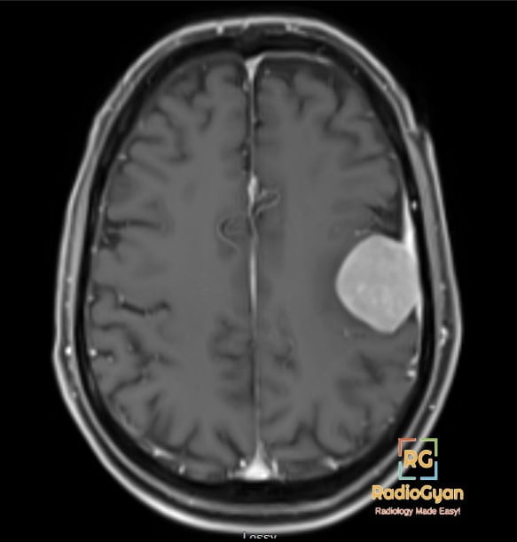 Axial post-contrast T1-weighted MRI showing a homogeneously enhancing left frontal convexity extra-axial mass with a dural tail