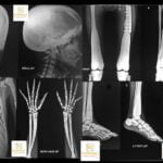 Osteopetrosis Radiology Case