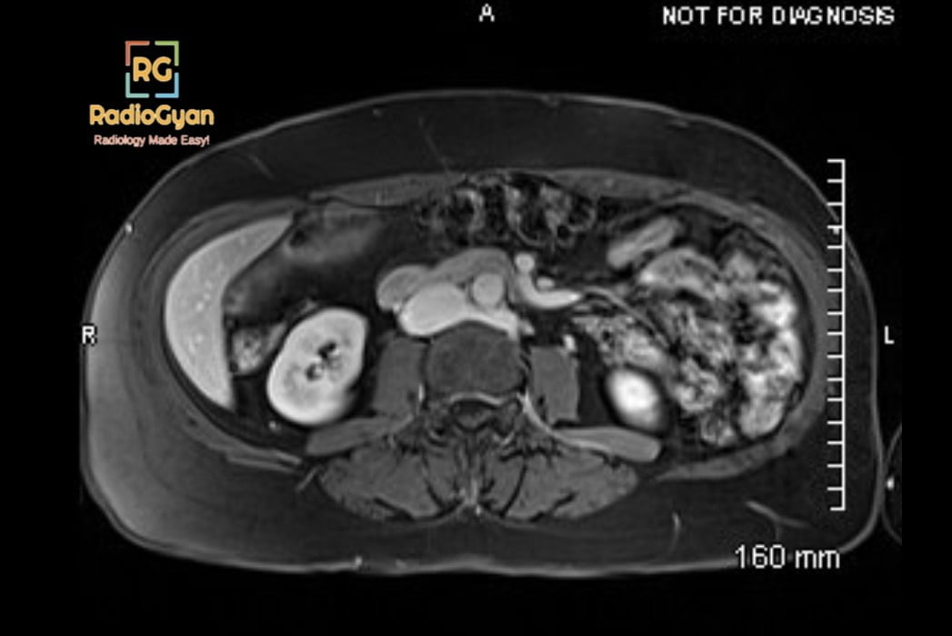 Axial contrast-enhanced MRI of the abdomen showing a retroaortic left renal vein, the anatomical variant underlying posterior nutcracker syndrome