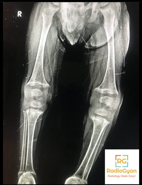 Lower limb radiograph in an older child with rickets showing bowing and widened cupped metaphyses at the knees and ankles