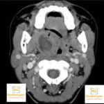 Right Tonsillar Abscess Radiology Case